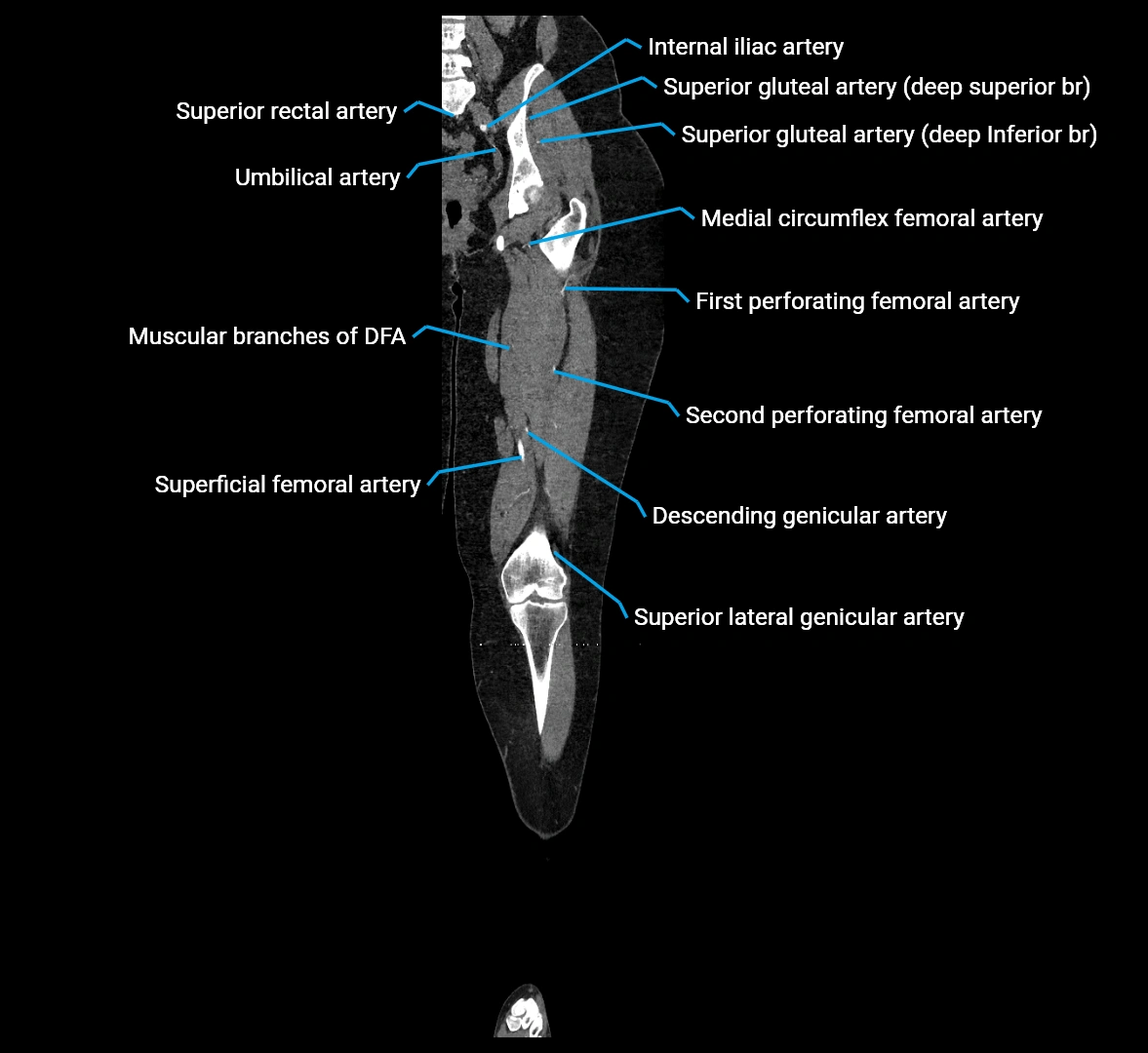 CTA lower limb coronal cross sectional anatomy labelled image _45 (2).webp